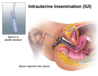 Insemination Pregnant Before After